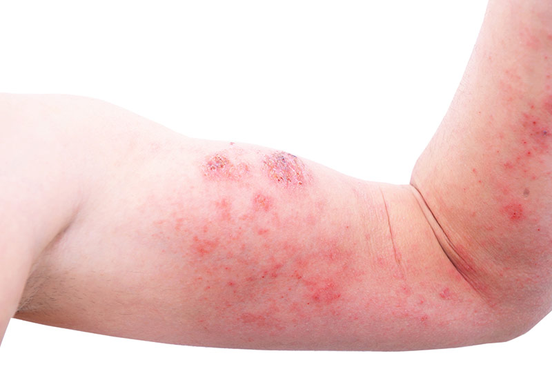 Atopic-Dermatitis Atopic Dermatitis Clinical Study