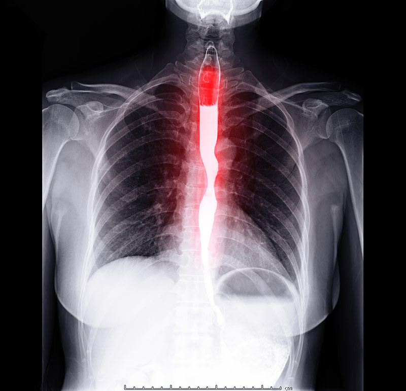 GERD Clinical Study GERD Clinical Study