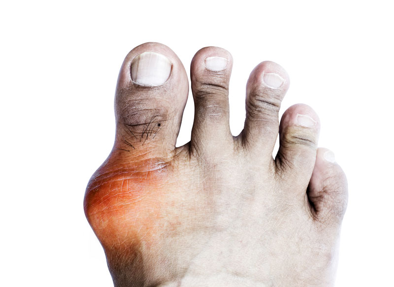 Gout-Clinical-Study Gout Clinical Study